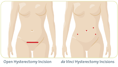 da vinci hysterctomy incisions